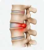 Ilustração de protrusão discal