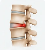 Ilustração de abaulamento discal